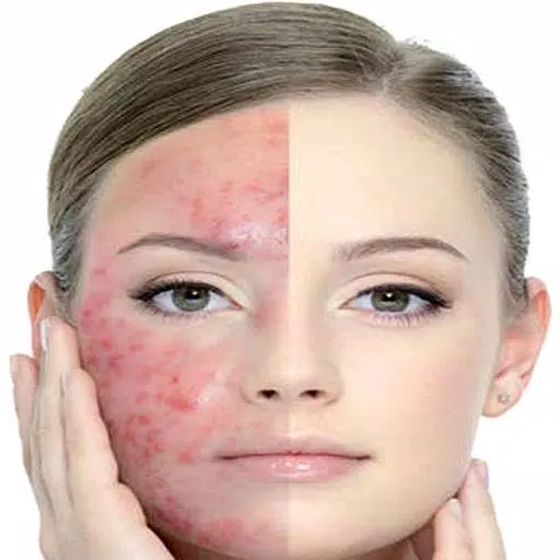 Get Rid of Acne  (Guide) Captura de pantalla 2